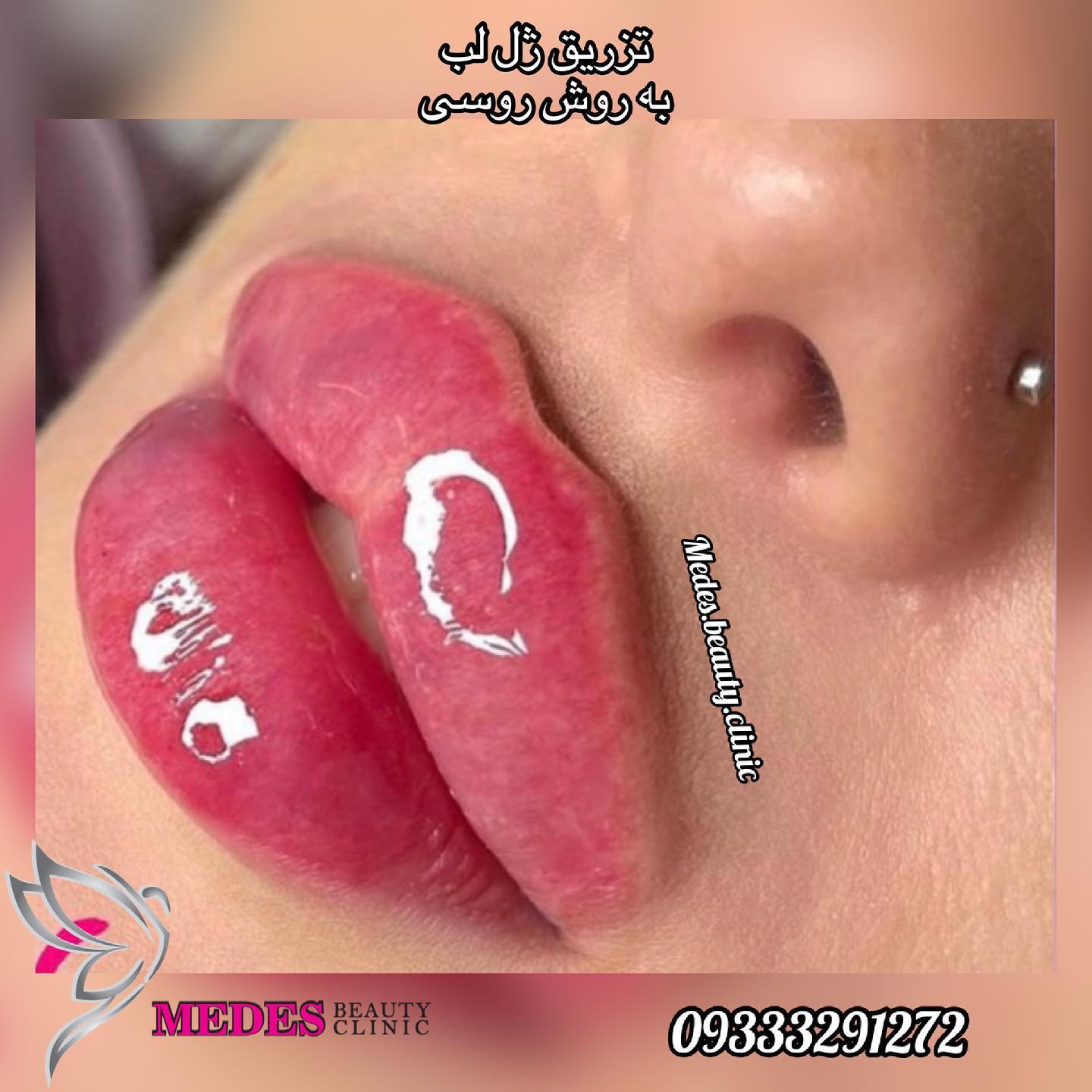 گالری تزریق ژل لب